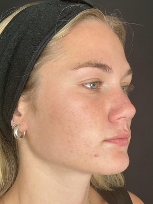 After Image: Case #8084 – SkinPen - right-front-oblique