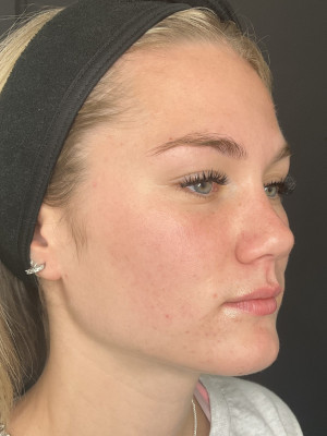Before Image: Case #8084 – SkinPen - right-front-oblique